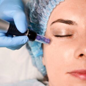 REJUVENECIMIENTO FACIAL CON DERMAPEN