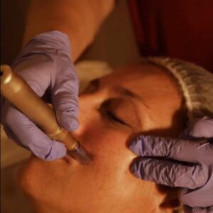 Tratamiento facial con exosomas